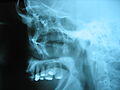 Radiographie niveaux de gris d'un crâne humain. Cette radiographie cephalametric latéral gauche montre un profil du crâne humain. Le maxillaire et des dents couronnées constituent la majeure partie de l'image. Ci-dessus que quatre faible ongles comme des structures sont visibles.