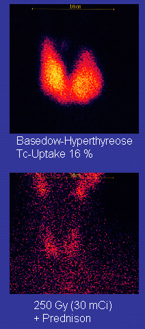 Image du haut: deux caractéristiques d'abandon comme fusionnés à leurs fonds; ils ont un centre jaune et une jante rouge sur un fond noir. Légende: Maladie Tc-absorption de Graves 16%. Basse photo: points rouges sur fond noir. Légende: 250 Gy (30mCi) + Prednison.