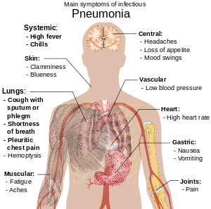 Un schéma du corps humain présentant les symptômes clés de la pneumonie