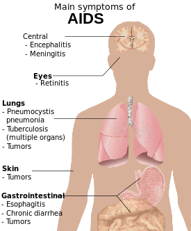 Un diagrama de un torso humano marcado con los síntomas más comunes del SIDA